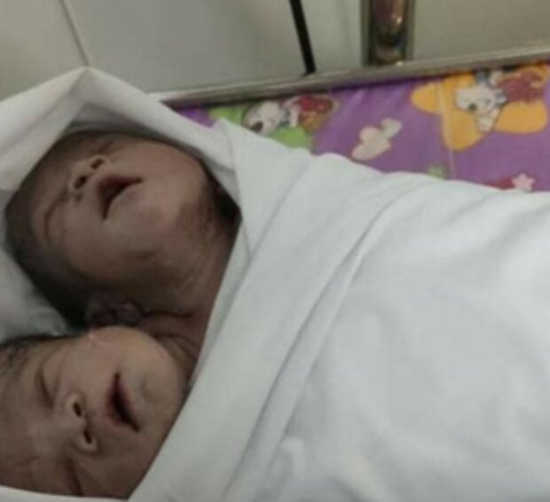 In Myanma wurde ein völlig gesundes Kind mit zwei Köpfen geboren