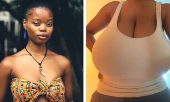 Wie sich das Leben eines Mädchens mit 13 Brustgröße nach der Verkleinerung verändert hat