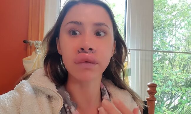 Erfolglose Lippenaufspritzung. Quelle: Youtube Screenshot