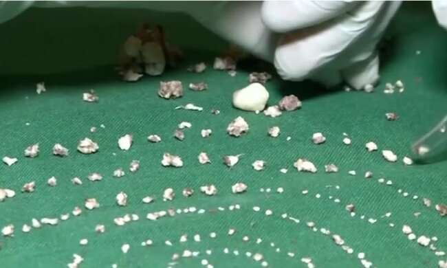 In Indien wurden die Ärzte dem 7-jährigen Jungen 526 Zähne entfernt