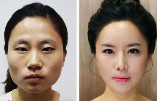 "Kirschlippen", Kieferverkleinerung, Nasenlochplastik: welche Operationen in Südkorea beliebt sind
