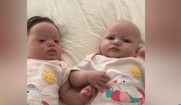 "Einmal in fünf Millionen": Frau brachte eineiige besondere Zwillinge zur Welt