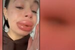 Hyaluronsäure statt Selbstliebe? Quelle: Youtube Screenshot