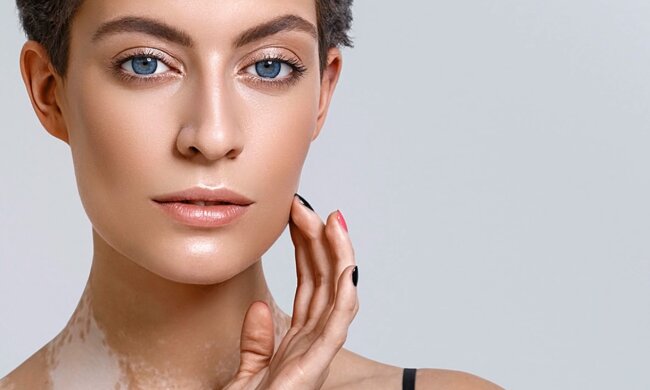 Die Frau mit dem Vitiligo.  Quelle: Screenshot YouTube