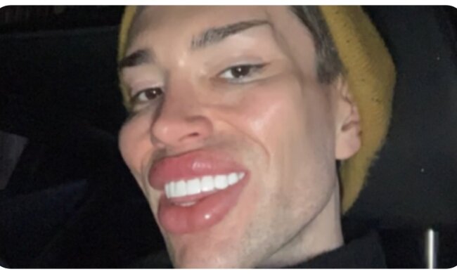 Plastic Botched Boy. Quelle: nypost.com
