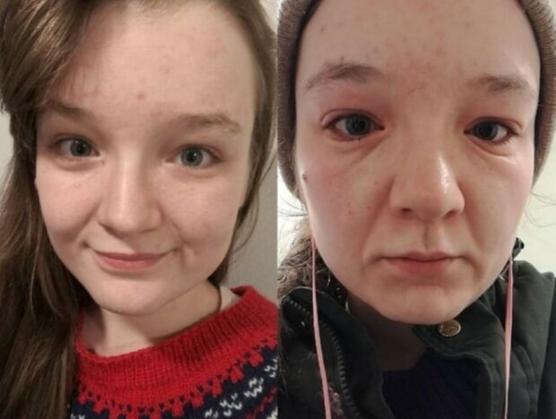 Eine junge Frau wird in wenigen Minuten ein paar Jahre älter, weil sie allergisch gegen Kälte ist