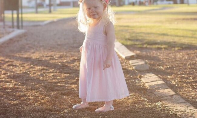 Albinomädchen. Quelle: Instagram.com