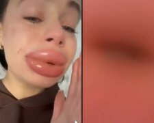 Hyaluronsäure statt Selbstliebe? Quelle: Youtube Screenshot