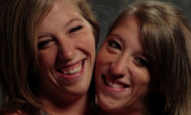 Die siamesischen Hensel-Zwillinge nach 30 Jahren: wie sie nach Jahren leben