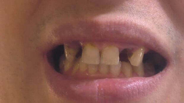 Mann hat sich noch nie in seinem Leben die Zähne geputzt. Quelle: Screen