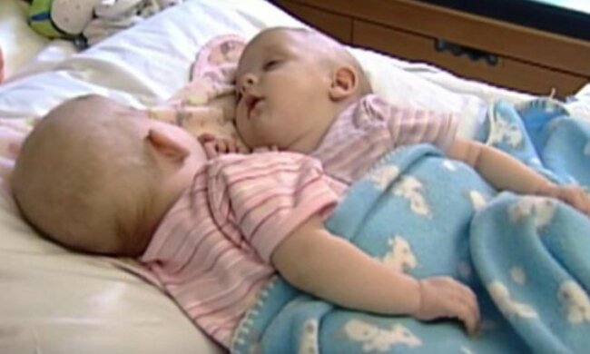 Vor 14 Jahren teilten Chirurgen die siamesischen Zwillinge und gaben den Mädchen ein neues Leben