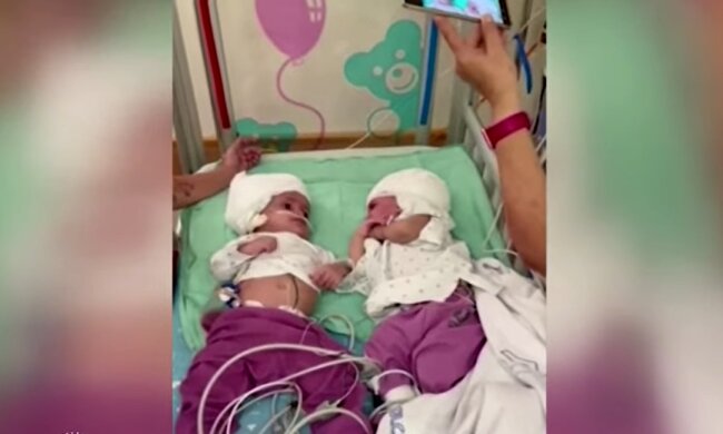 Siamesische Zwillinge. Quelle: Youtube Screenshot