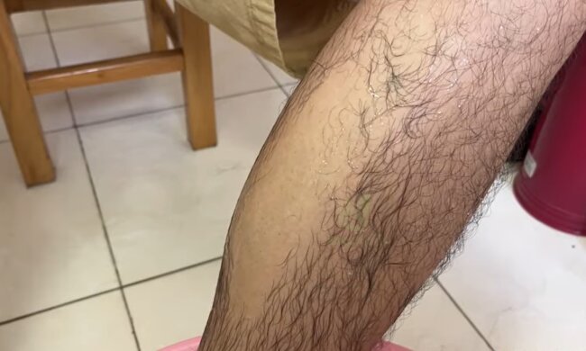 Bein-Epilation. Quelle: Youtube Screenshot