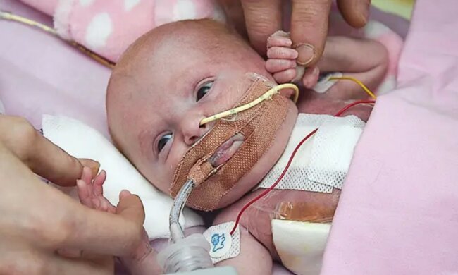 Britische Ärzte retteten ein Baby, das mit dem Herz außer dem Brustkorb geboren wurde