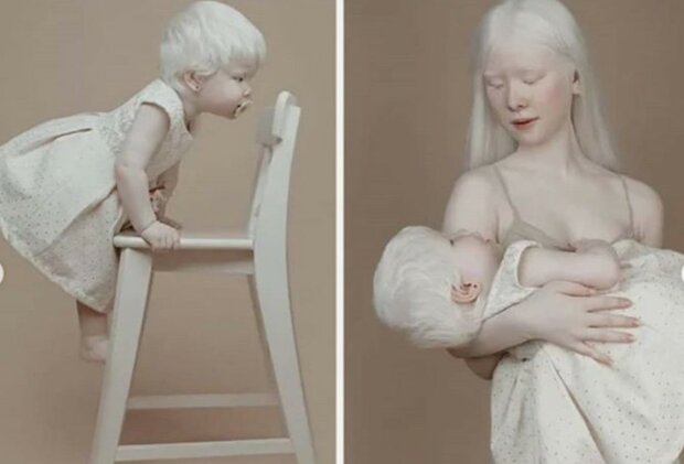 Porzellanhaut und schneeweißes Haar: zwei Kinder mit Albinismus wachsen in der Familie auf