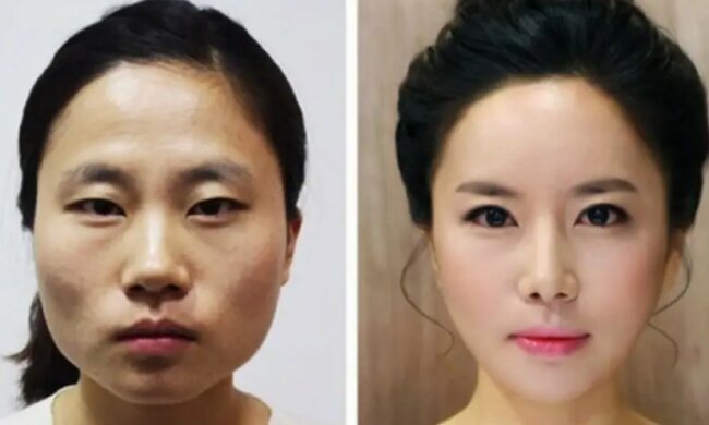 "Kirschlippen", Kieferverkleinerung, Nasenlochplastik: welche Operationen in Südkorea beliebt sind
