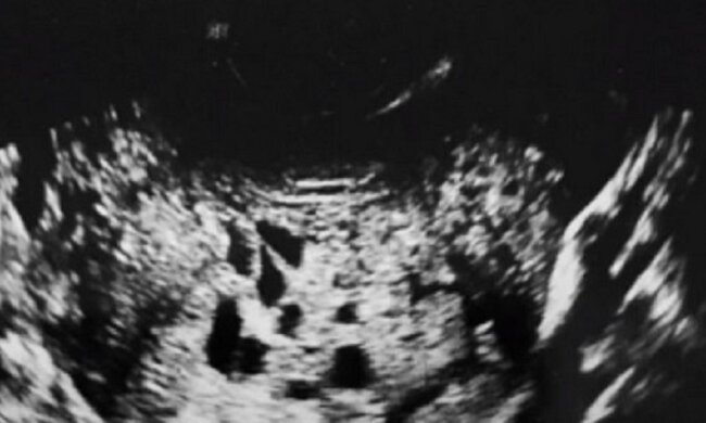 Der Schwangerschaftstest war positiv: Die Frau hatte jedoch keine Ahnung, dass sie kein Baby im Bauch trug