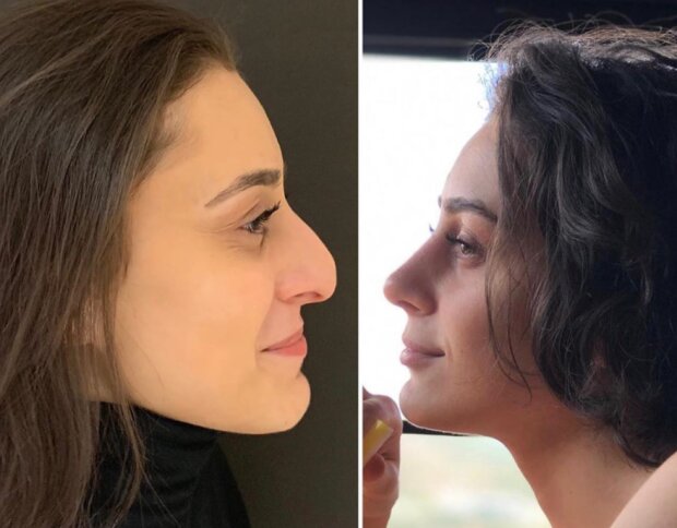 Wie sich junge Frauen nach einer Nasenoperation veränderten