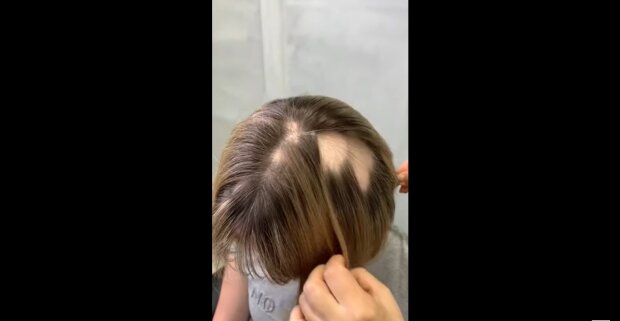 Frau mit Glatze. Quelle: Youtube Screenshot