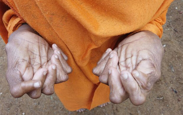 Die Frau, die 31 Finger und Zehen hat