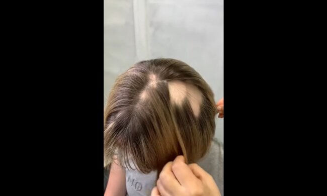 Frau mit Glatze. Quelle: Youtube Screenshot