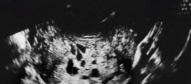 Der Schwangerschaftstest war positiv: Die Frau hatte jedoch keine Ahnung, dass sie kein Baby im Bauch trug