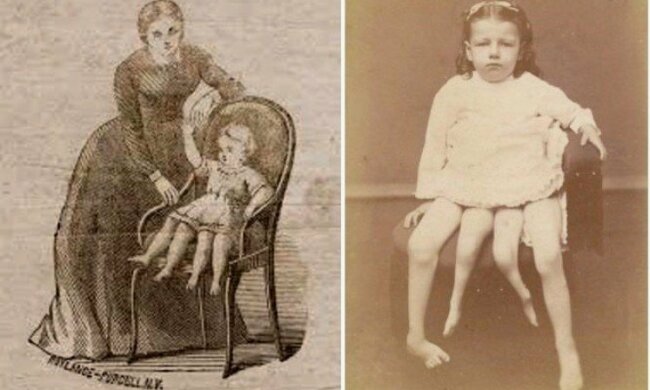 Die Geschichte von Josephine Myrtle: das Mädchen mit vier Beinen