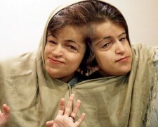 Das Recht aufs Leben: Wie das Leben der berühmten siamesischen Zwillinge verläuft
