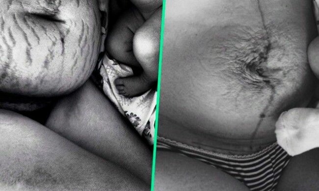 Der Preis des Glücks: so sieht der Körper einer Frau nach der Geburt wirklich aus