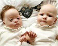 Zwillinge “einmal pro Million”: Einer wurde als besonderer geboren, der zweite nicht