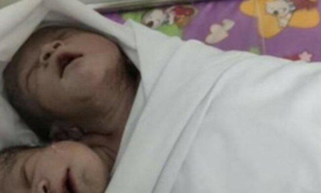 In Myanma wurde ein völlig gesundes Kind mit zwei Köpfen geboren