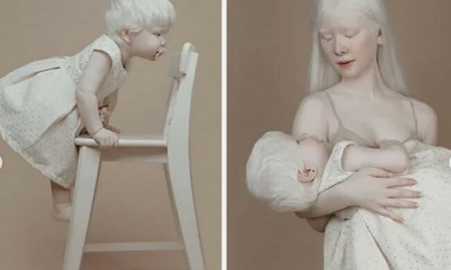 Porzellanhaut und schneeweißes Haar: zwei Kinder mit Albinismus wachsen in der Familie auf