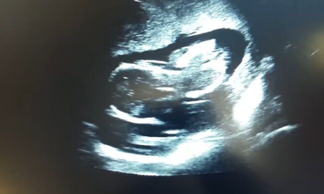 Ärzte bemerkten seltsame Konturen im Ultraschallbild des Babys: Jetzt sehen Passanten das Mädchen überrascht an