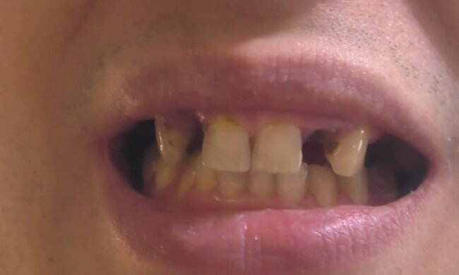 Mann hat sich noch nie in seinem Leben die Zähne geputzt. Quelle: Screen