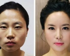 "Kirschlippen", Kieferverkleinerung, Nasenlochplastik: welche Operationen in Südkorea beliebt sind