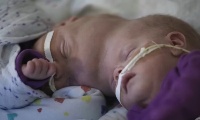 Siamesische Zwillinge. Quelle: Youtube Screenshot