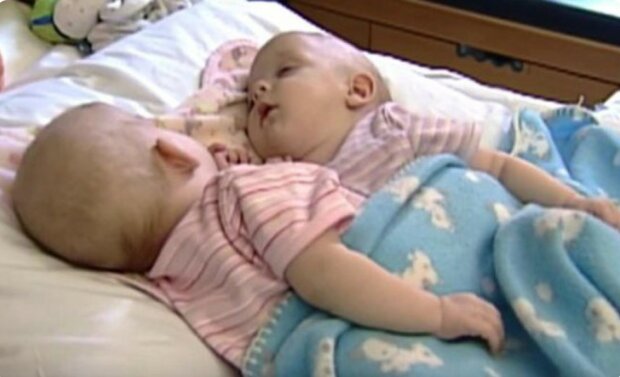 Vor 14 Jahren teilten Chirurgen die siamesischen Zwillinge und gaben den Mädchen ein neues Leben