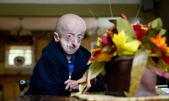 Vorzeitige Alterung: ein 16-jähriger Junge, der wie 60-jähriger Mann aussieht