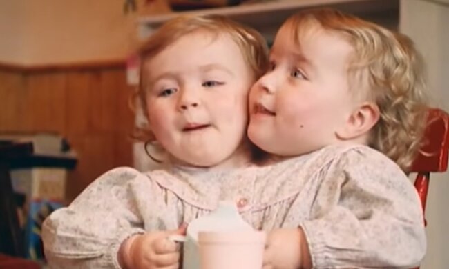 Siamesische Zwillinge. Quelle: YouTube Screenshot