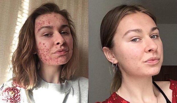 Ein Mädchen konnte ihren Gesichtsausschlag behandeln.  Quelle: www. vinegred.сom