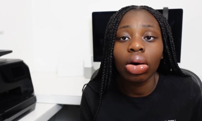 Lippenvergrößerung. Quelle: Youtube Screenshot