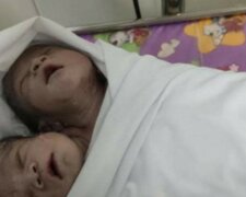In Myanma wurde ein völlig gesundes Kind mit zwei Köpfen geboren