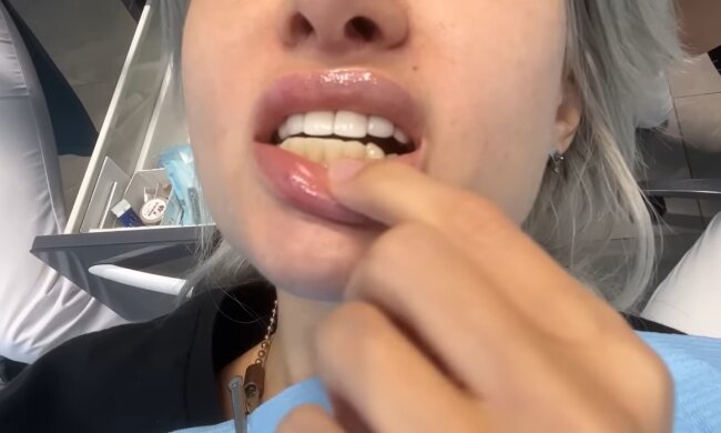 Veneers. Quelle: Youtube Screenshot
