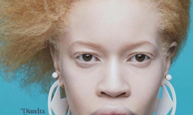 Wie Albino-Frau Diandra Forrest ein gefragtes Modell wurde