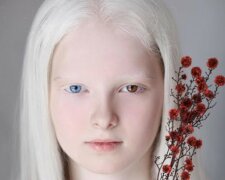 "Unauffälliges Aussehen": wie ein Albino-Mädchen mit verschiedenen Augen aussieht
