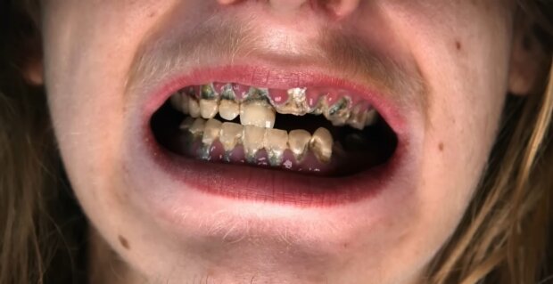 Probleme mit den Zähnen. Quelle: Youtube Screenshot
