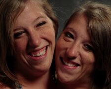 Die siamesischen Hensel-Zwillinge nach 30 Jahren: wie sie nach Jahren leben