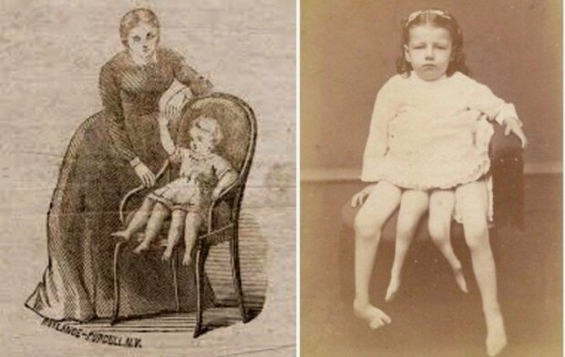 Die Geschichte von Josephine Myrtle: das Mädchen mit vier Beinen