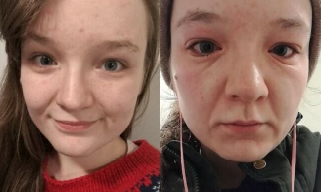 Eine junge Frau wird in wenigen Minuten ein paar Jahre älter, weil sie allergisch gegen Kälte ist