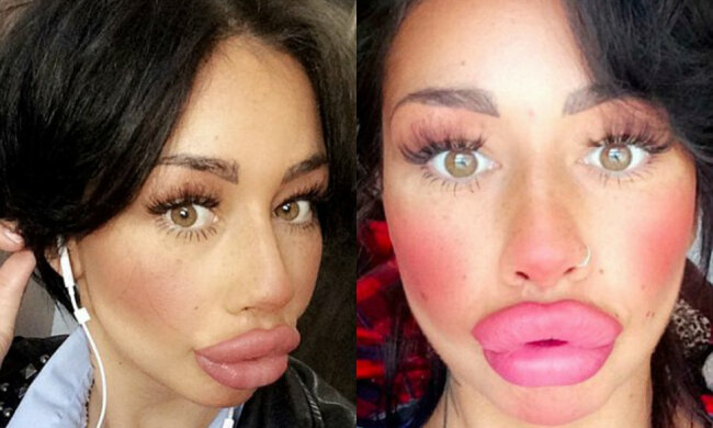 Die Perfektion hat keine Grenzen: Warum die junge Frau nicht aufhört, ihre Lippen zu vergrößern